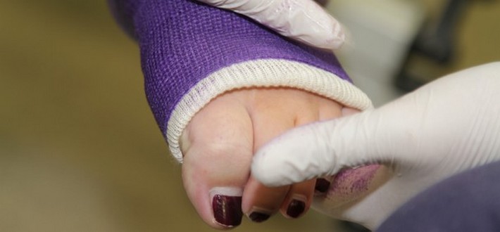 plaster cast