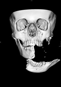3D CT scan of Emilys jaw before surgery