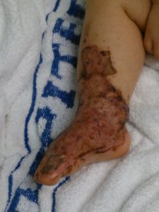 Burns Awareness