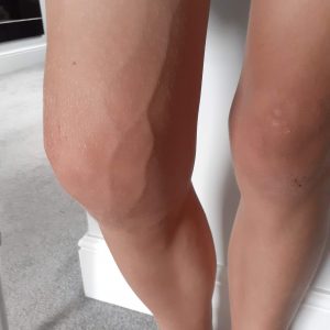 Swollen knee