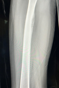 Sophie osteomyelitis scan